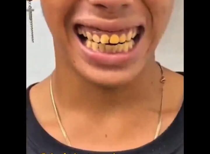 Cómo Blanquear los Dientes de Forma Natural