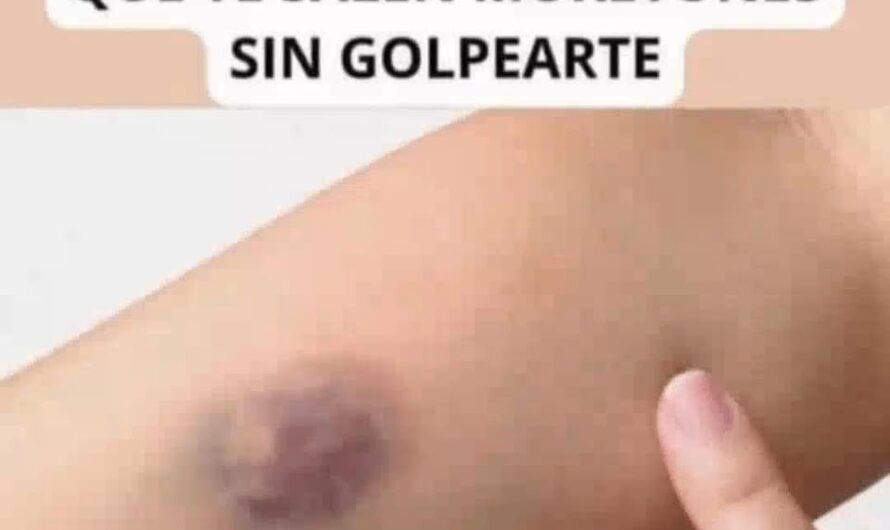 Más Allá de los Golpes: Razones por las que Aparecen Moretones sin Causa Aparente