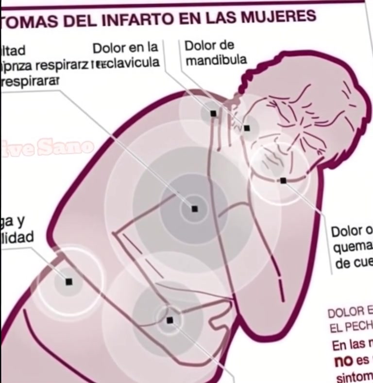 Infarto en Mujeres: Señales Atípicas que Muchas Pasan por Alto - Noticias