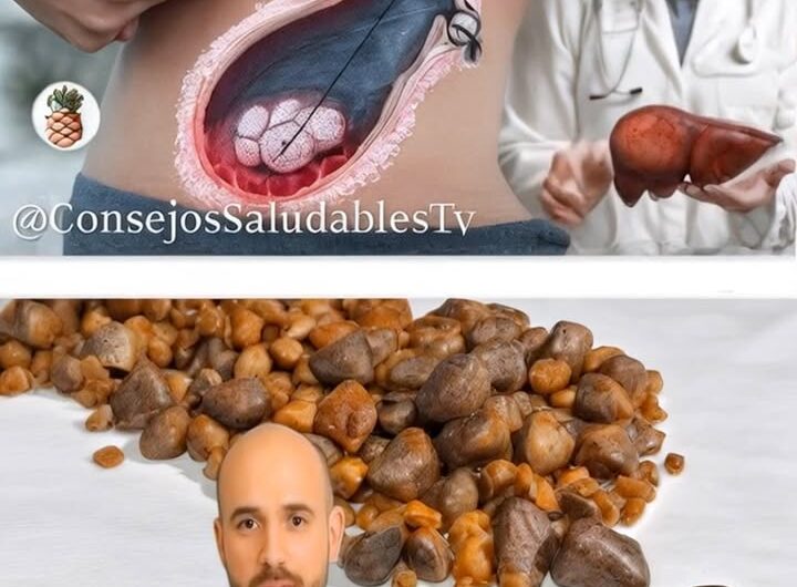 Cálculos Renales: Un Camino Natural de Apoyo, no de Cura Milagrosa