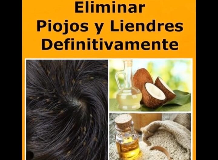 Cómo elim1nar los piojos y liendres de forma natural y efectiva