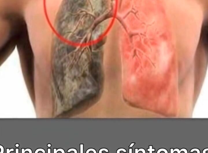 Principales síntomas que pueden indicar cáncer de pulmón