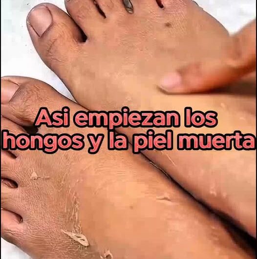 Hongos en los Pies: Causas y Remedios Naturales para Combatirlos