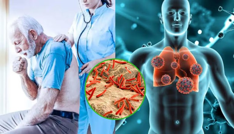 “La tuberculosis: un desafío global invisible que sigue afectando al mundo”