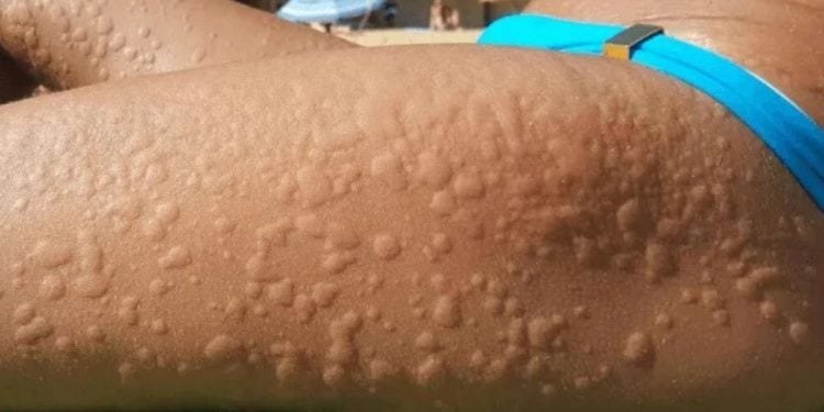 Alivio Natural para la Urticaria: Calma la Piel con Ingredientes de la Despensa