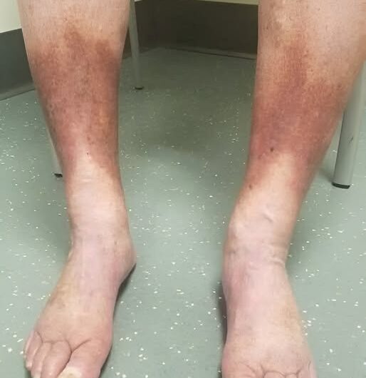 Urticaria en los Pies: Una Molestia con Solución