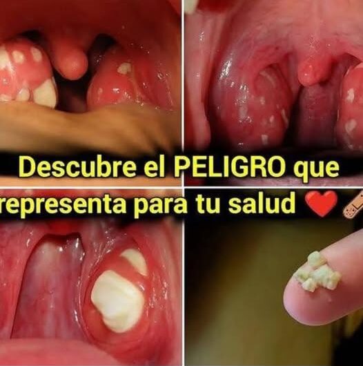 Combate el Mal Aliento de Forma Natural y Efectiva