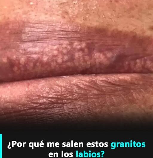 Cómo evitar la aparición visible de los granos de Fordyce