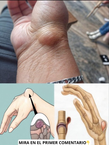 Quistes de Ganglio en la Muñeca: Causas, Síntomas y Remedios Naturales
