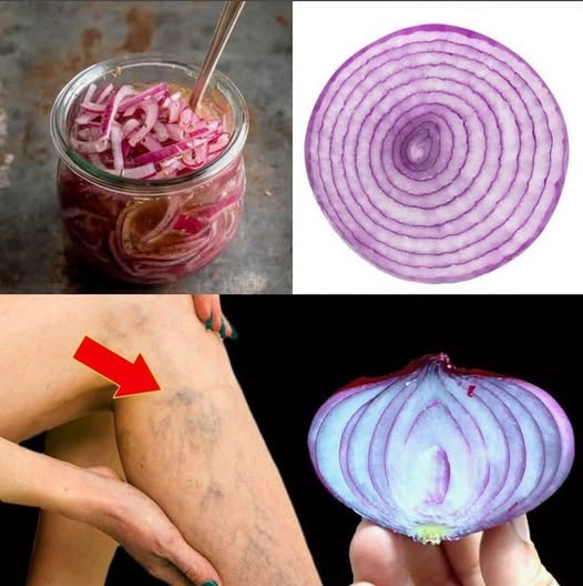 "Adiós a las varices: métodos efectivos y consejos prácticos para eliminarlas de raíz"