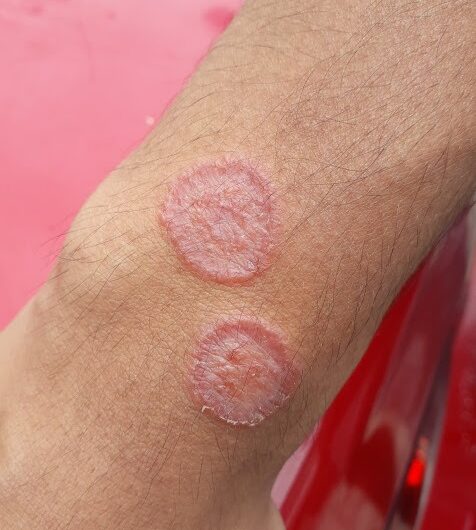 Hongos en la Pierna: Cuidado Natural para una Piel Sana