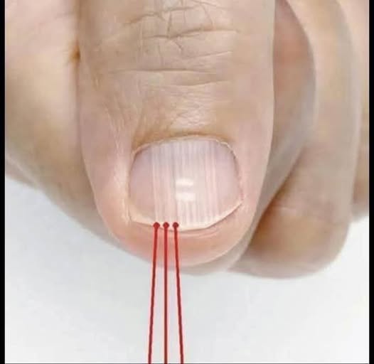¿Qué significan las rayas en las uñas y cómo cuidarlas de manera natural?