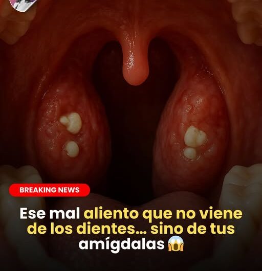 "Cuando el mal aliento proviene de las amígdalas y no de tus dientes"