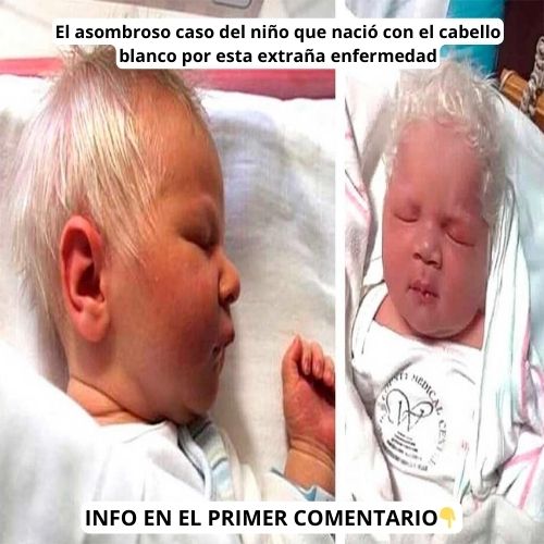 El Asombroso Caso del Niño que Nació con Cabello Blanco: Comprendiendo la Enfermedad de Waardenburg