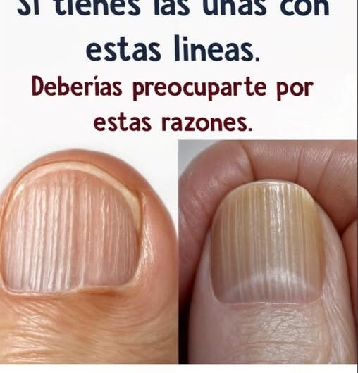 ¿Tienes líneas en las uñas? Descubre las causas y cómo tratarlas