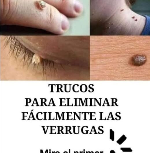 Remedios caseros efectivos para eliminar las verrugas de forma natural