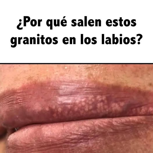 “Descubre por qué aparecen granitos en los labios y cómo aliviarlos”