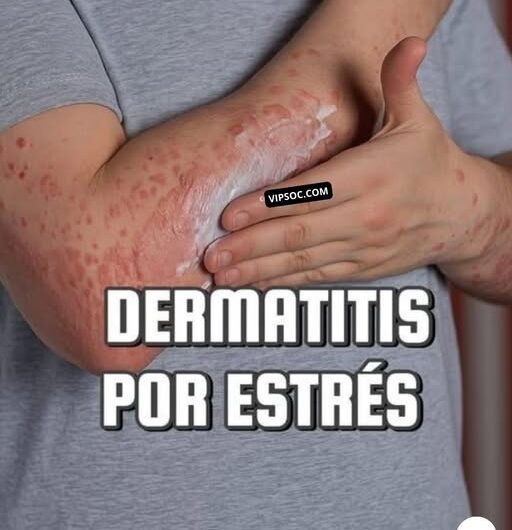 Dermatitis por Estrés: Cómo el Estrés se Manifiesta en Nuestra Piel