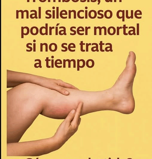 Trombosis: Comprendiendo el Riesgo de un Asesino Silencioso
