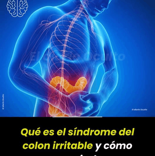 ¿Qué es el Síndrome del Colon Irritable (SCI)?
