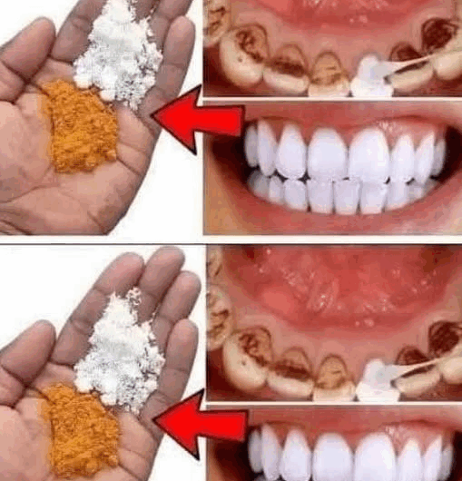 “El método natural para blanquear tus dientes usando solo 2 ingredientes”