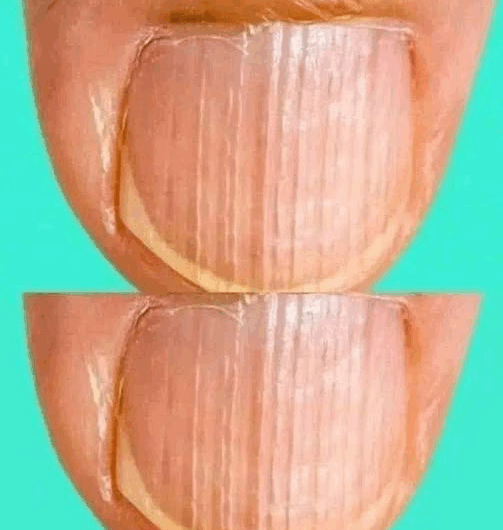 “Tener uñas con rayas: causas y consejos para mantenerlas saludables”