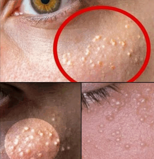 Granitos blancos en el rostro: causas, cuidados y remedios naturales