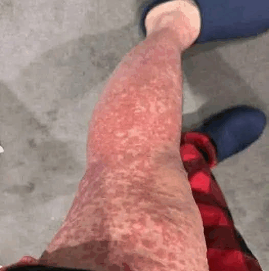 “Las manchas rojas en las piernas: por qué aparecen y cómo cuidarlas”