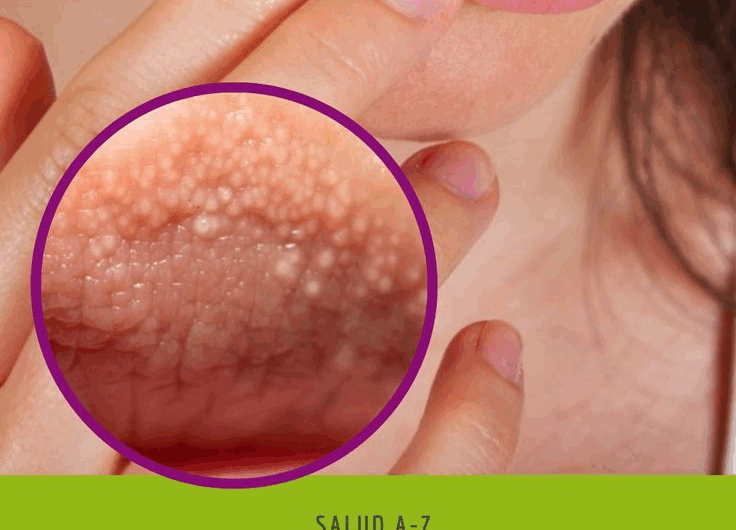 Granitos en los labios: más que un simple problema estético