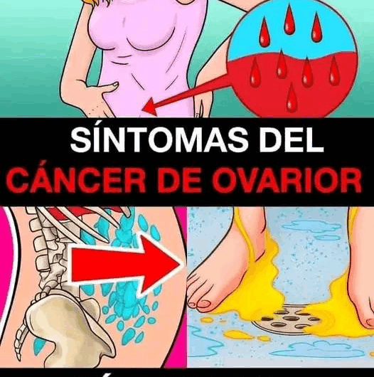 Descubre 7 señales silenciosas que podrían ser cánc3r de ovarios