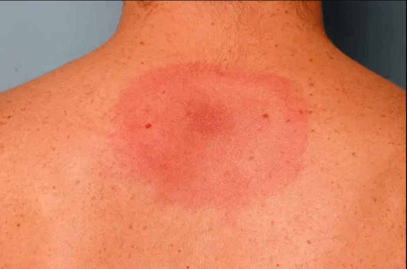 ¿Qué hay detrás de una picadura de garrapata? Descubre los riesgos que no conocías