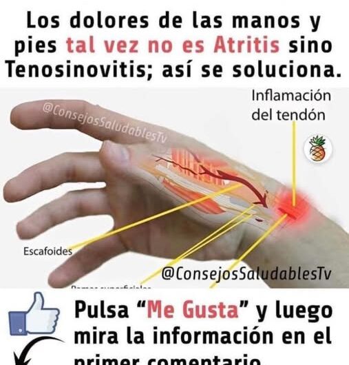 Tendosinovitis: Soluciones Naturales para Aliviar el Dolor