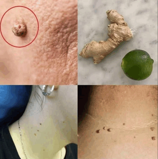 Recetas Naturales para Eliminar Verrugas