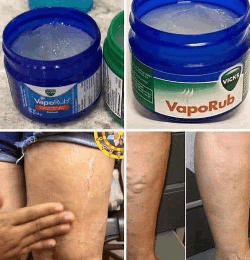 Remedio Natural Integral para Combatir las Varices