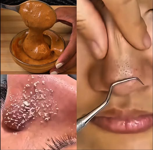 Mascarillas Caseras para un Rostro Libre de Espinillas y Puntos Negros