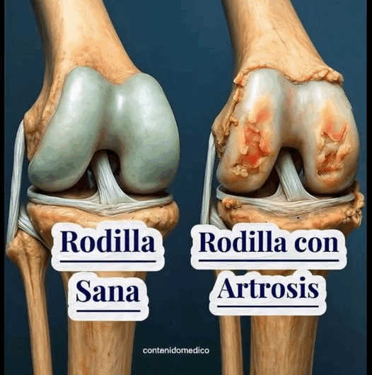 La Artrosis de Rodilla: Causas y Recetas Naturales Complementarias