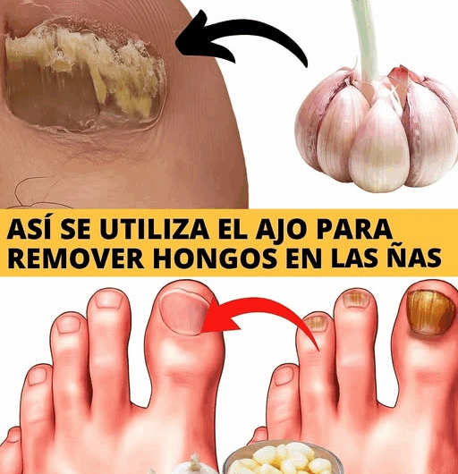 “Nadie te lo había contado: el ajo elimina los hongos de forma natural”