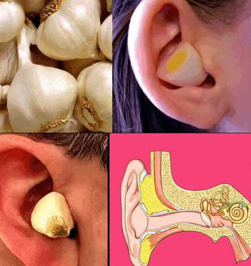 El Poder del Ajo en el Oído: El Remedio Natural que Alivia el Dolor y las Infecciones