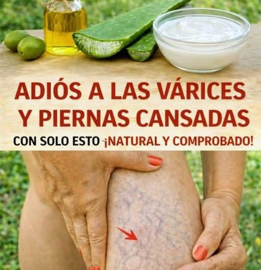 Recetas naturales para ayudar a reducir las várices