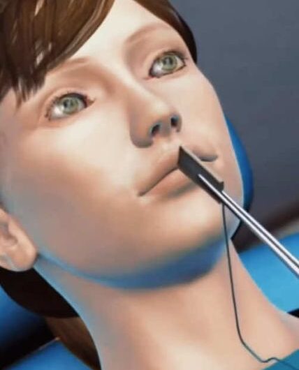 Cirugía endoscópica para el tratamiento de la sinusitis