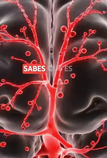 ¿Qué es un derrame cerebral y qué sucede dentro del cerebro?