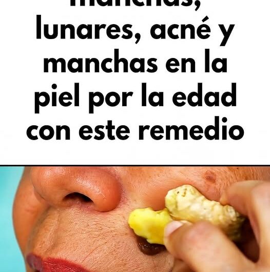 El Remedio Casero Más Usado para las Verrugas: Cómo Secarlas Naturalmente con Vinagre de Manzana