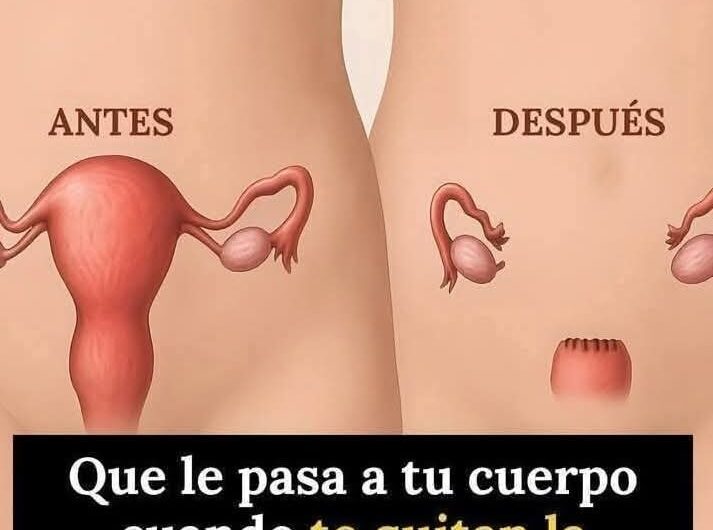 Los Efectos de la Histerectomía en el Cuerpo Femenino: Lo Que No Te Cuentan