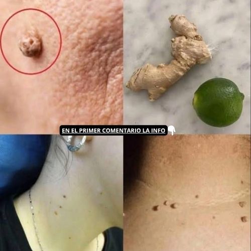 Las Verrugas Caen Como Hojas: Un Tratamiento Casero Efectivo